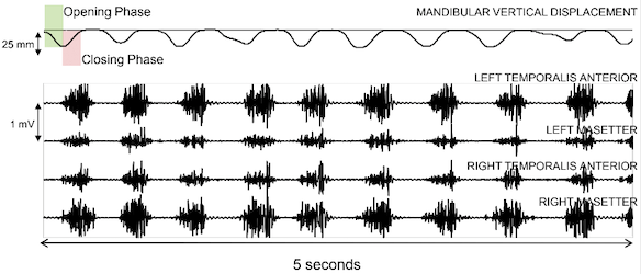kinematic and emg assessment chewing analysis