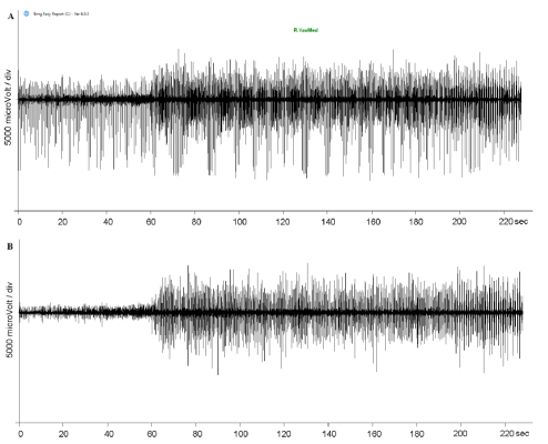 wavelet filter artifacts removal