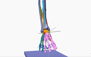 equinus foot deformity